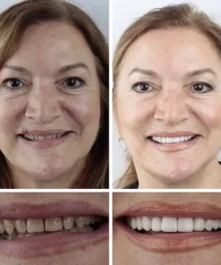 CLINCLII™ --Advanced Customized Full Denture Set