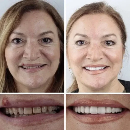 CLINCLII™ --Advanced Customized Full Denture Set