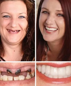 CLINCLII™ --Advanced Customized Full Denture Set