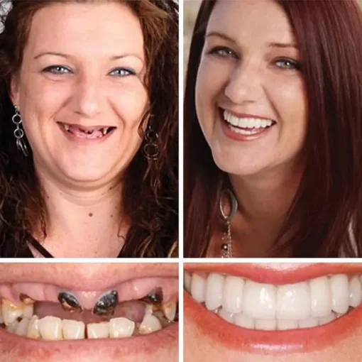 CLINCLII™ --Advanced Customized Full Denture Set