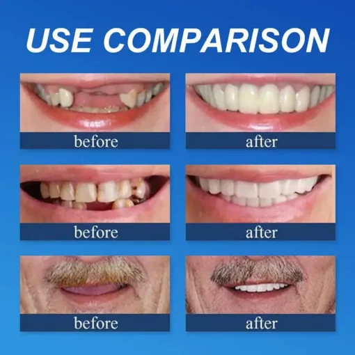 CLINCLII™ --Advanced Customized Full Denture Set