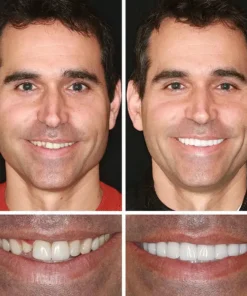 CLINCLII™ --Advanced Customized Full Denture Set