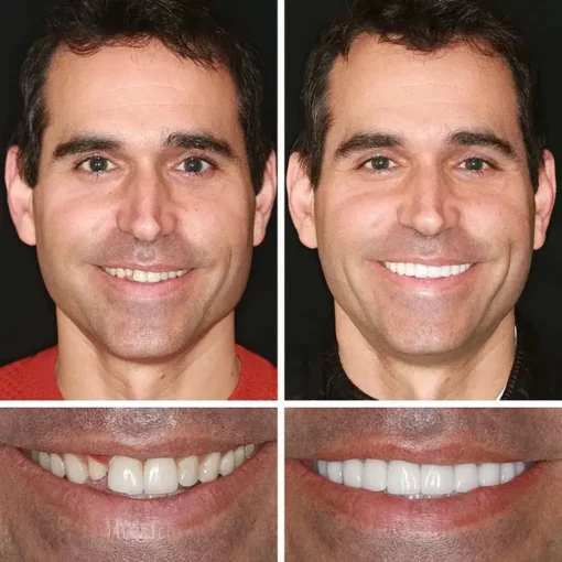 CLINCLII™ --Advanced Customized Full Denture Set