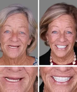 CLINCLII™ --Advanced Customized Full Denture Set
