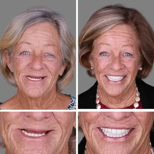 CLINCLII™ --Advanced Customized Full Denture Set