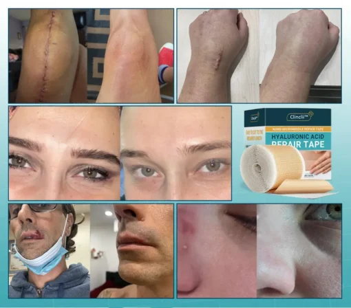Clinclii™ Hyaluronic Acid Nano Microneedle Repair Tape