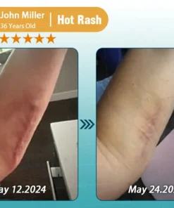 Clinclii™ Hyaluronic Acid Nano Microneedle Repair Tape