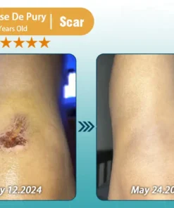 Clinclii™ Hyaluronic Acid Nano Microneedle Repair Tape