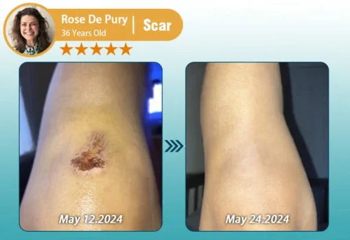 Clinclii™ Hyaluronic Acid Nano Microneedle Repair Tape