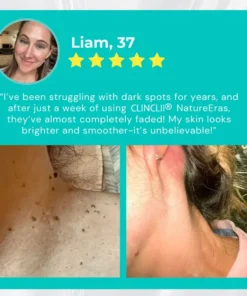 Clinclii™ NatureErase Instant Mole & Spot Cream