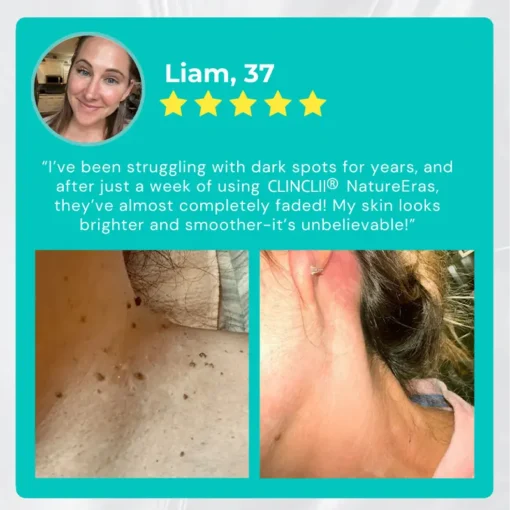 Clinclii™ NatureErase Instant Mole & Spot Cream