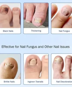 Clinclii Fungus Nail Patches-Suitable for Solving Fungal Nails