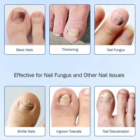 Clinclii Fungus Nail Patches-Suitable for Solving Fungal Nails